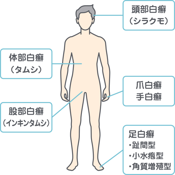 頭部白癬（シラクモ）・体部白癬（タムシ）・爪白癬・手白癬・股部白癬（インキンタムシ）・足白癬（趾間型、小水疱型、角質増殖型）ができる箇所を示したイメージ